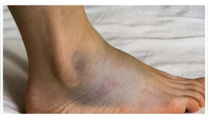 Skin Deep: 7 Subtle Skin Signs That Could Signal Heart Disease