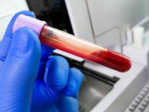 Blood Type A Linked to Higher Early Stroke Risk, New Study Reveals
