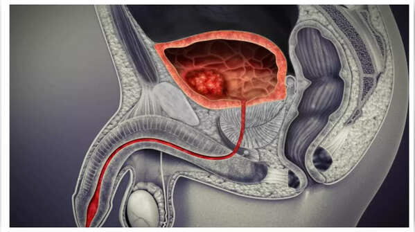 Change in urine color could indicate bladder cancer