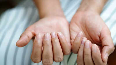 Damaged nails after extension removal