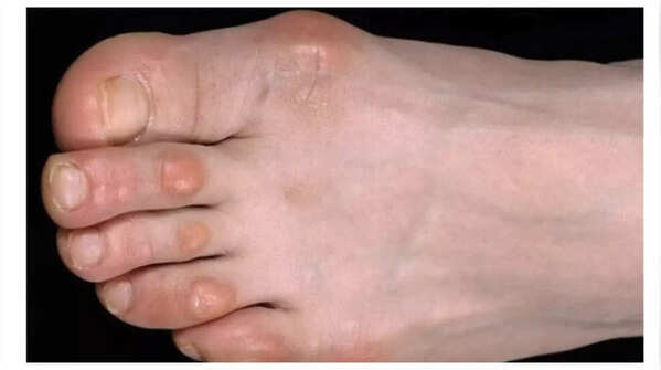 Painful lumps on fingers or toes could be a sign of heart problems