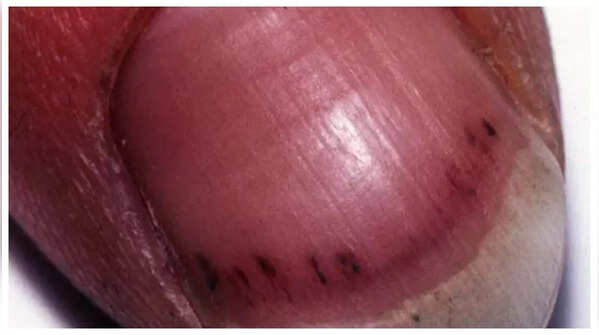 Red or purple lines under nails may indicate a heart infection