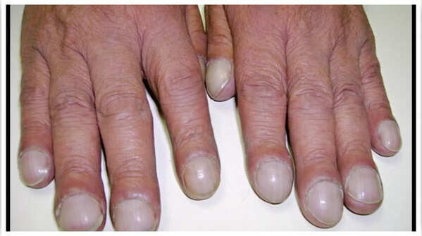 Changes in nail shape can be indicative of heart issues