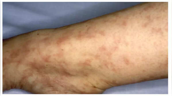Net-like purple pattern may signal cholesterol embolization