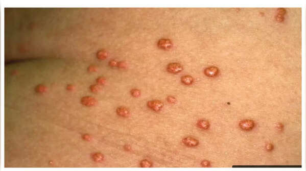 Yellowish-orange bumps on skin: a cholesterol warning sign
