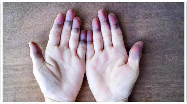 Blue or purple skin discoloration can indicate heart problems
